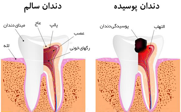 سهم دندان‌های مکمل در پوسیدگی بیشتر دندان‌ها